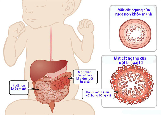 Viêm ruột ở trẻ em: Nguyên nhân, Triệu chứng và Cách Điều Trị Hiệu Quả