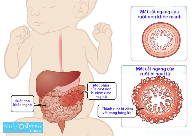 Viêm Ruột Non Ở Trẻ Em